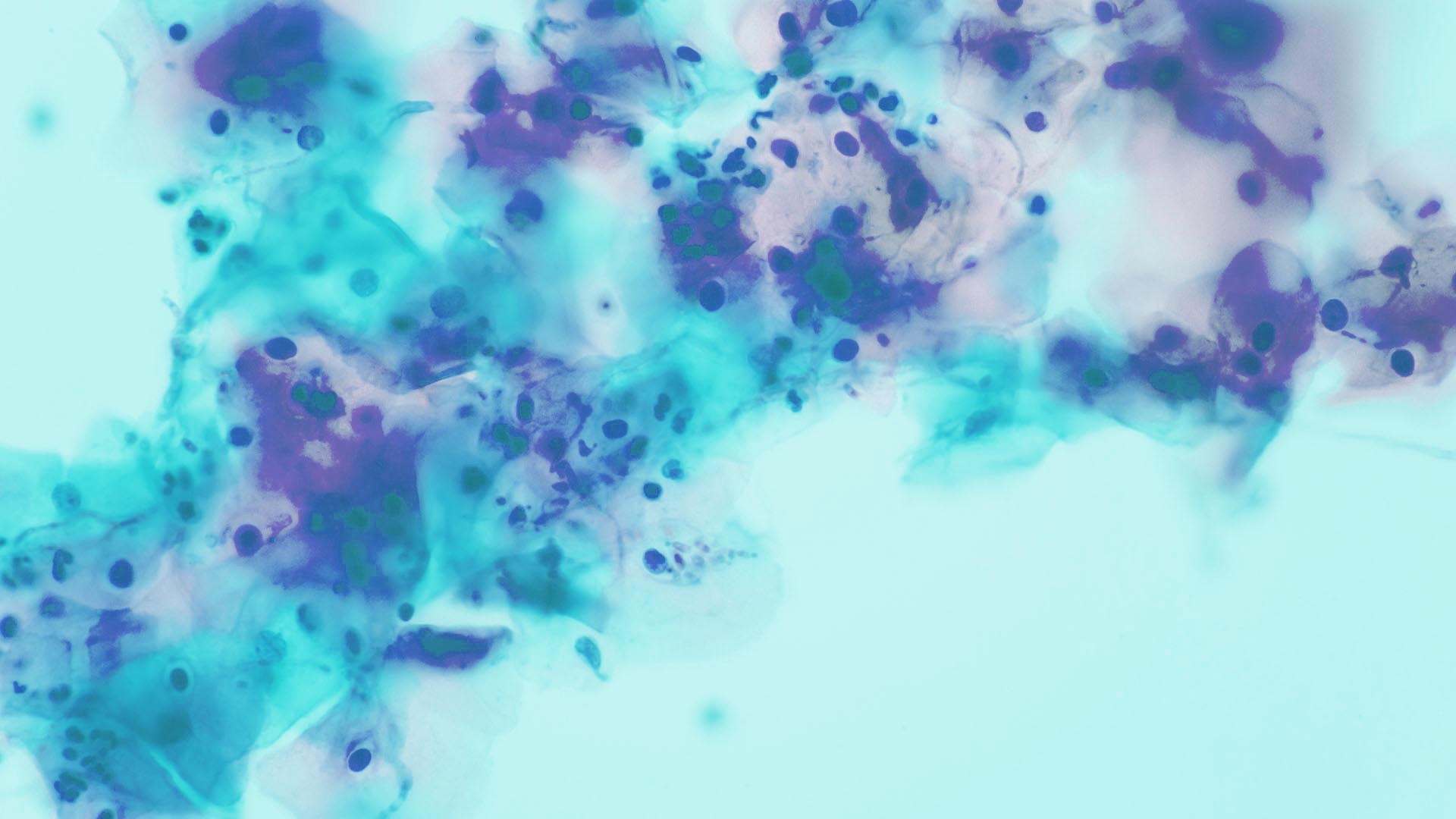ESCMID and ECMM joint clinical guidelines for the diagnosis and management of mucormycosis 2013